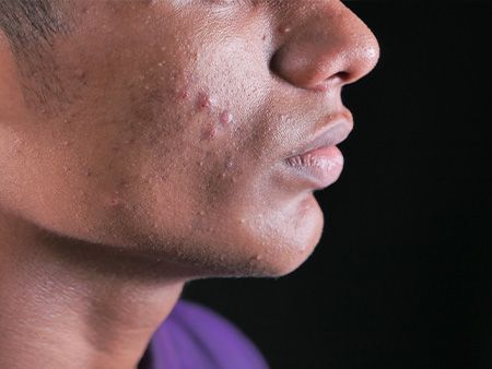 ePGA for Acne background