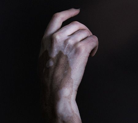 ePGA for Vitiligo background